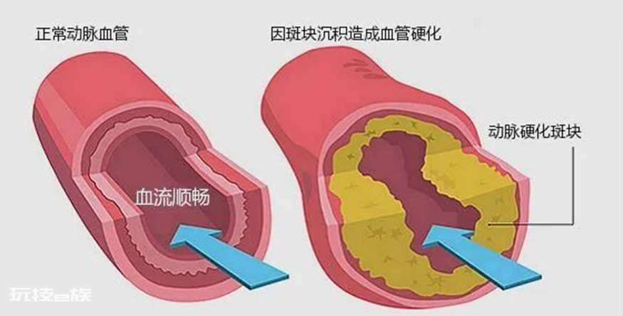 全国血管健康日丨警惕血管病变的信号